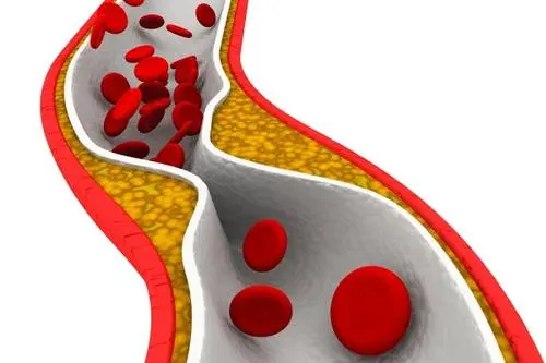 细胞营养素能治疗颈动脉斑块吗