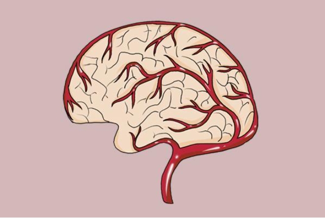 造成老年痴呆的原因是大脑长期供血不足引起的